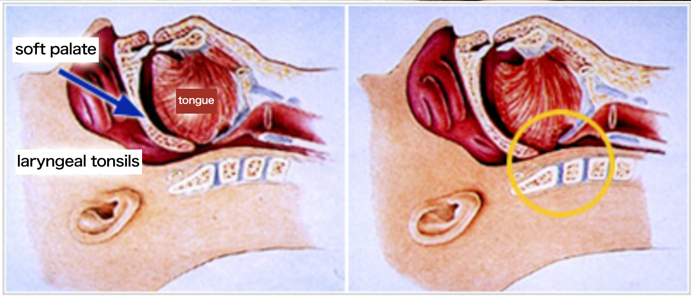 Snoring Diagram