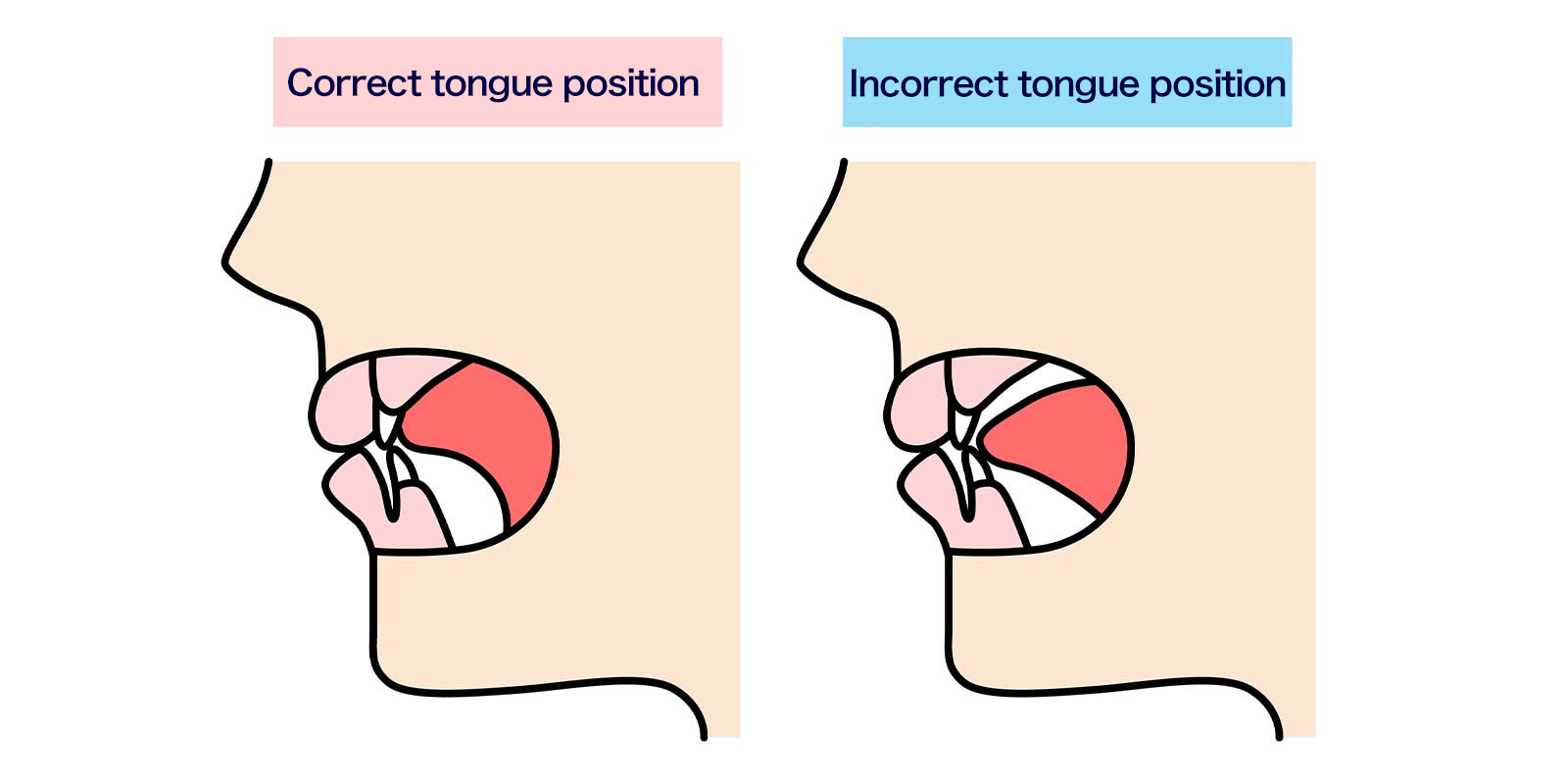 mouth breathing