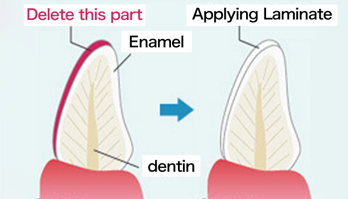 Laminate Veneer