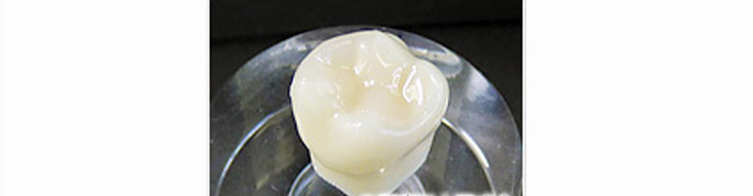 Hybrid Ceramic Inlay