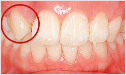 右上の2番目の歯が重なっている口腔内の写真