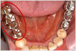 右奥に銀歯のブリッジが入っている口腔内の写真