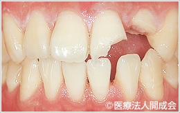 左の前歯2本が折れてしまっている口腔内の写真