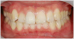 歯の根っこの治療をしてからオールセラミックのかぶせ物を入れた口腔内の写真