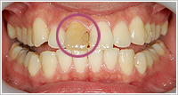 右前歯だけ色が変わってしまっている口腔内の写真