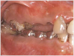 虫歯で右奥の歯が無くなってしまっている口腔内の画像