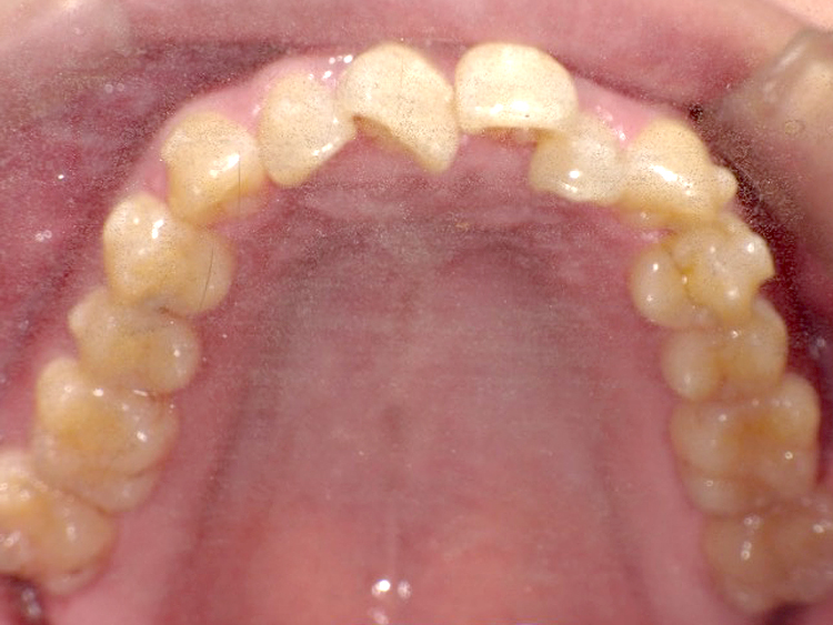 インビザラインの症例