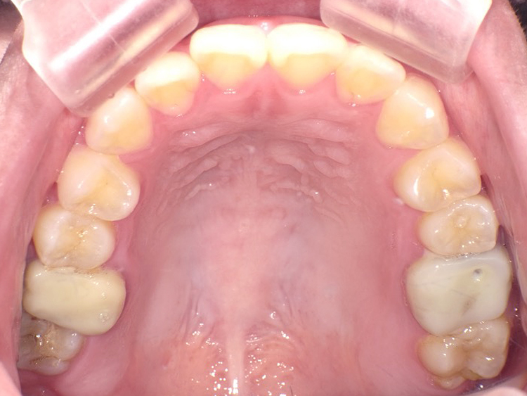 インビザラインの症例