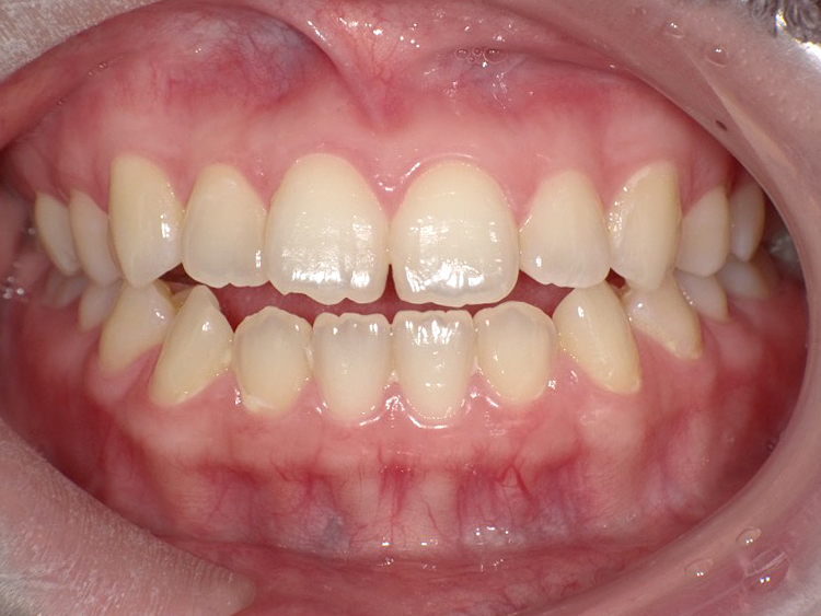 インビザラインの症例