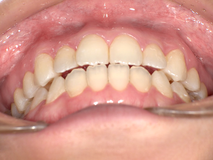 インビザラインの症例