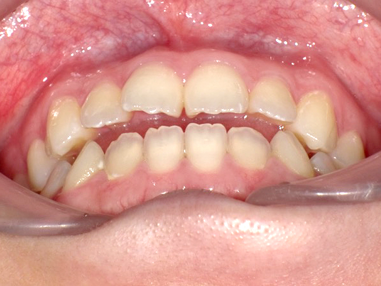 インビザラインの症例