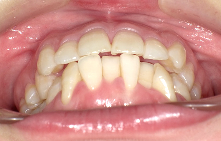 部分矯正の症例写真