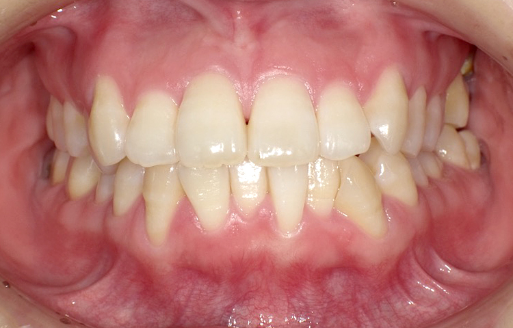 部分矯正の症例写真