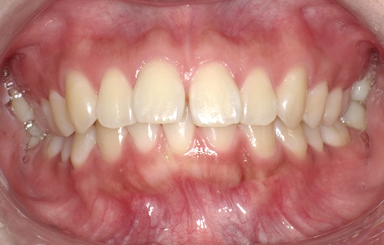 部分矯正の症例写真