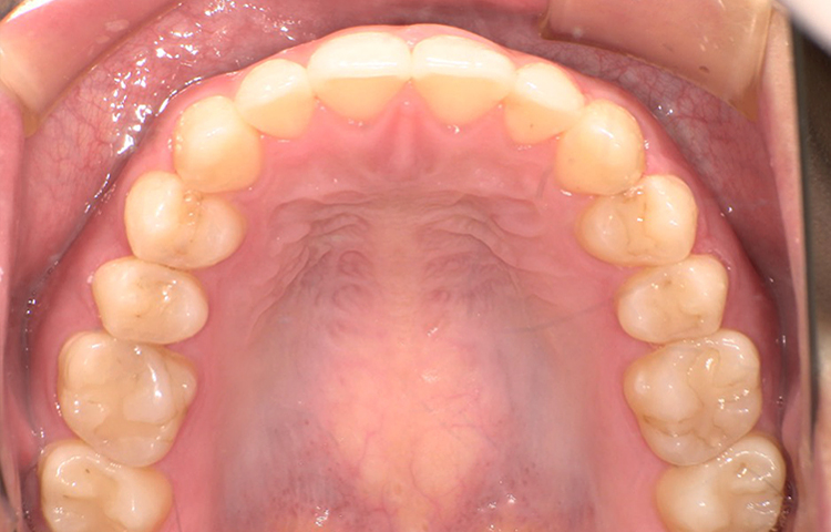 部分矯正の症例写真