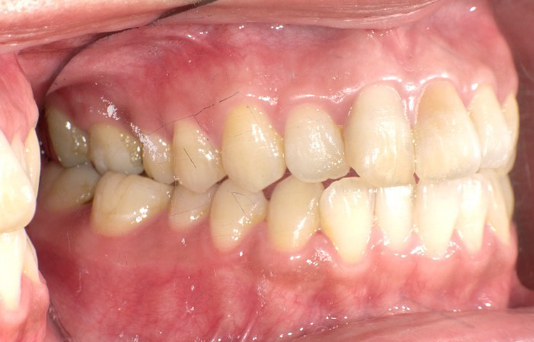 部分矯正の症例