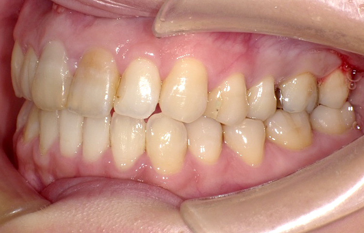 部分矯正の症例