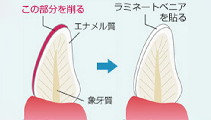 ラミネートべニア